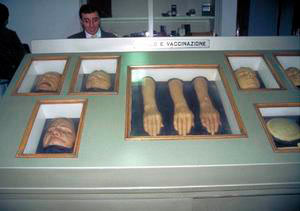 Wax models illustrating the effects of infectious diseases, the Military Centre of Forensic Medicine, Florence.